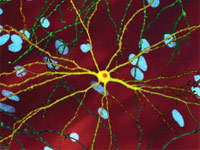 Neuronas afectadas con huntingtina