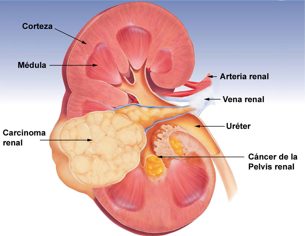 C�ncer de ri��n y de pelvis renal.