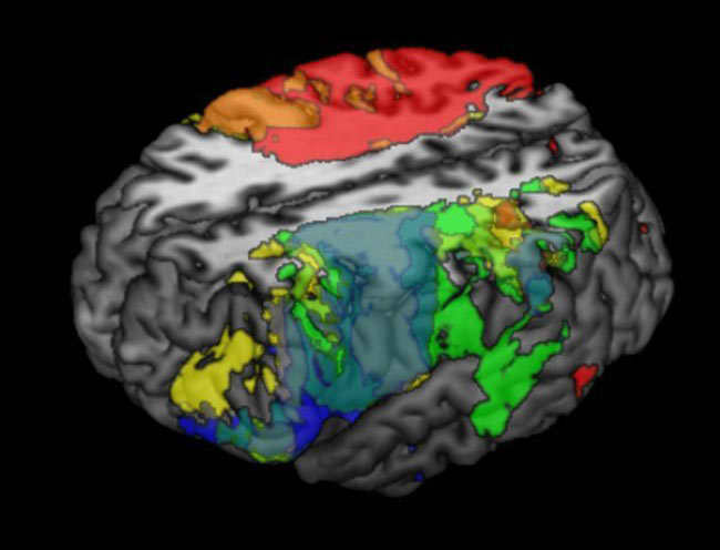 Mapa cerebral avanzado. Se realizaron esc�neres cerebrales a 241 personas con alg�n d�ficit cognitivo. Todas estas im�genes fueron despu�s relacionadas con las puntuaciones de dichas personas en el test de inteligencia WAIS. As�, pudieron relacionarse diversas partes del cerebro con las puntuaciones obtenidas en diferentes indicadores de inteligencia, como la capacidad ling��stica o la memoria de trabajo