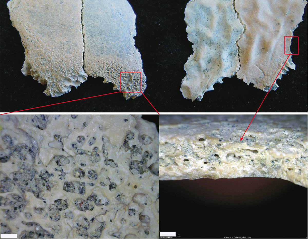 Fragmentos del parietal del niño de Olduvai. Abajo, las lesiones interpretadas como anemia