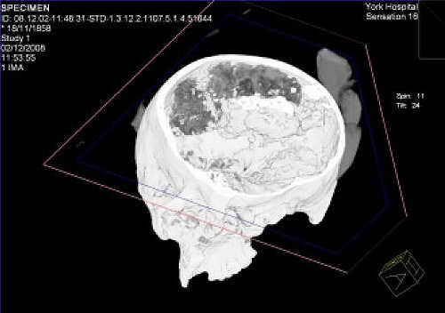 Tejido cerebral en la parte superior de un cr�neo desenterrado en Gran Breta�a con m�s de 2 mil a��os de antig�edad.